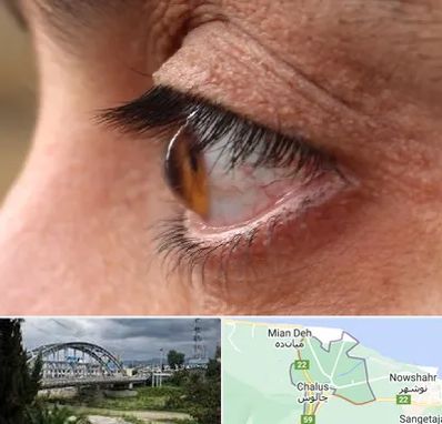 متخصص قوز قرنیه در چالوس