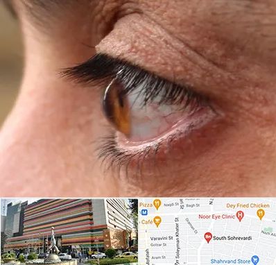 متخصص قوز قرنیه در سهروردی 