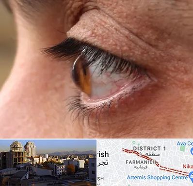 متخصص قوز قرنیه در فرمانیه 