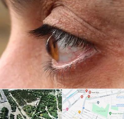 متخصص قوز قرنیه در سالاریه قم