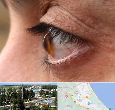 متخصص قوز قرنیه در رودسر