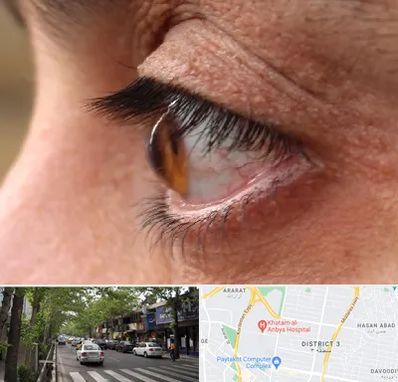 متخصص قوز قرنیه در ظفر 