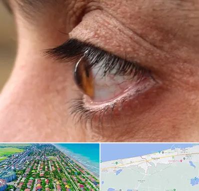 متخصص قوز قرنیه در فریدونکنار