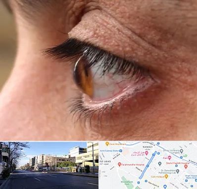 متخصص قوز قرنیه در خیابان ملاصدرا شیراز