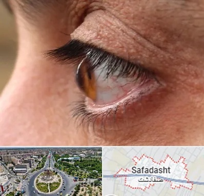 متخصص قوز قرنیه در صفادشت