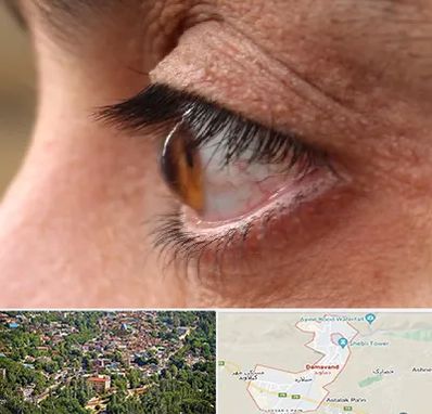 متخصص قوز قرنیه در دماوند