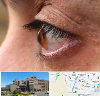 متخصص قوز قرنیه در صیاد شیرازی مشهد