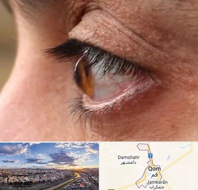 متخصص قوز قرنیه در قم