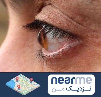 متخصص قوز قرنیه در نزدیک من