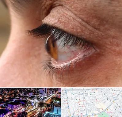 متخصص قوز قرنیه در منظریه رشت