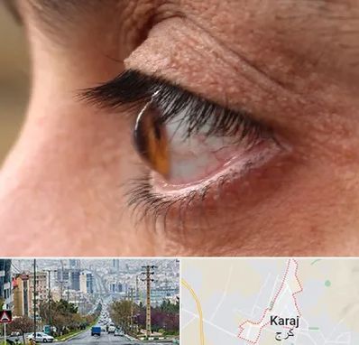 متخصص قوز قرنیه در گوهردشت کرج 