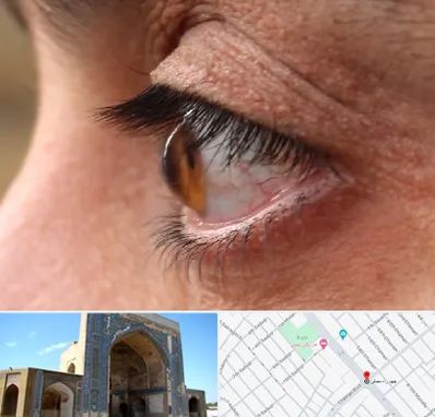 متخصص قوز قرنیه در مصلی مشهد