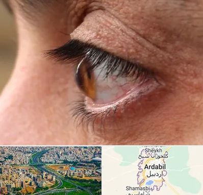 متخصص قوز قرنیه در اردبیل