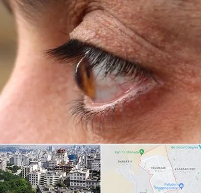 متخصص قوز قرنیه در ولنجک 