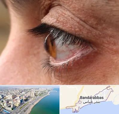 متخصص قوز قرنیه در بندرعباس