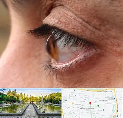 متخصص قوز قرنیه در سرسبز 