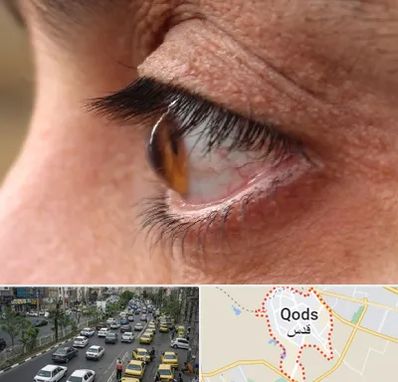 متخصص قوز قرنیه در شهر قدس