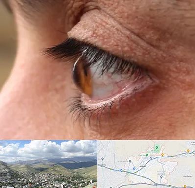 متخصص قوز قرنیه در رودهن