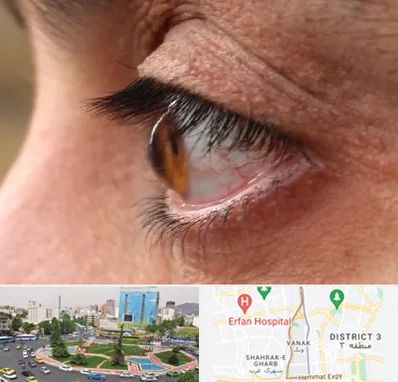 متخصص قوز قرنیه در ونک 