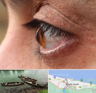 متخصص قوز قرنیه در بندر انزلی