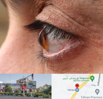 متخصص قوز قرنیه در هروی 