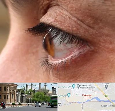 متخصص قوز قرنیه در پاکدشت