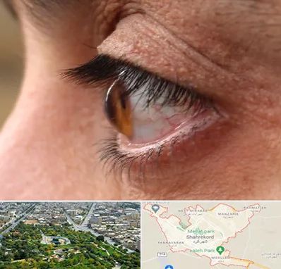 متخصص قوز قرنیه در شهرکرد