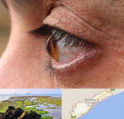 متخصص قوز قرنیه در بندرلنگه