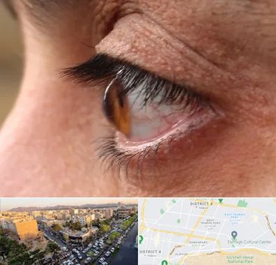 متخصص قوز قرنیه در تهرانپارس 