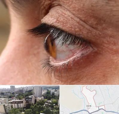 متخصص قوز قرنیه در اوین