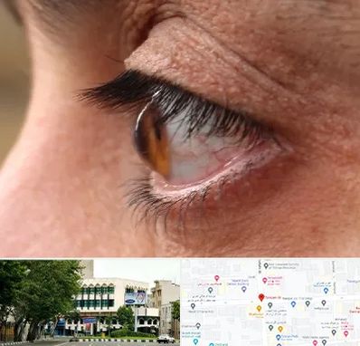 متخصص قوز قرنیه در طالقانی 