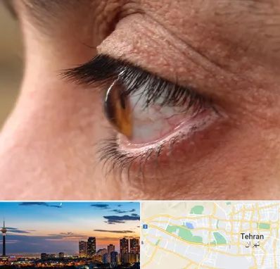 متخصص قوز قرنیه در غرب تهران 