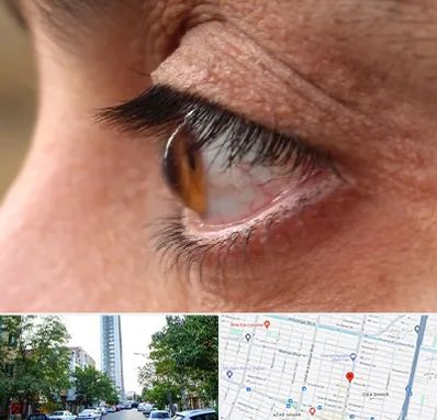 متخصص قوز قرنیه در امامت مشهد