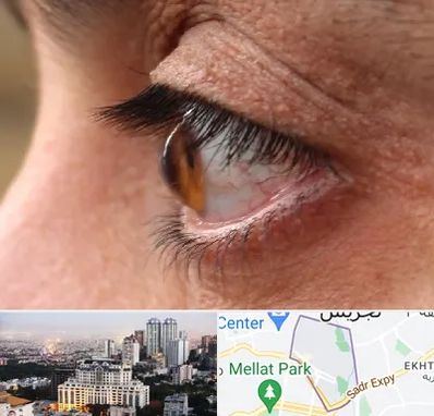 متخصص قوز قرنیه در الهیه 