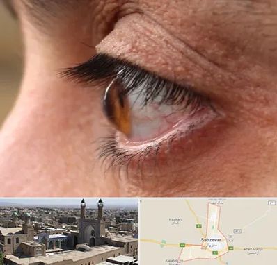 متخصص قوز قرنیه در سبزوار