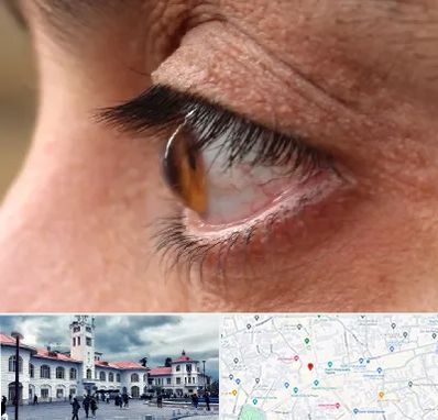 متخصص قوز قرنیه در میدان شهرداری رشت