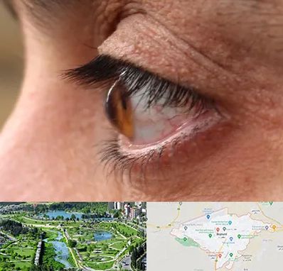 متخصص قوز قرنیه در بجنورد