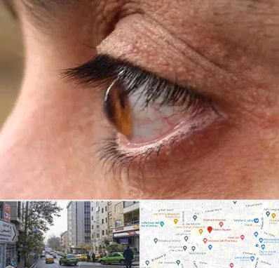 متخصص قوز قرنیه در فاطمی 