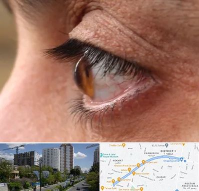 متخصص قوز قرنیه در اندرزگو