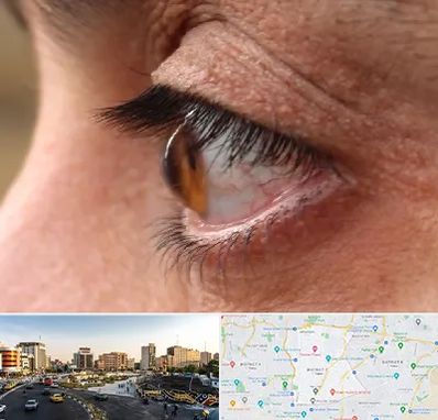 متخصص قوز قرنیه در منطقه 7 تهران 