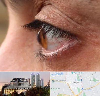 متخصص قوز قرنیه در فرشته 