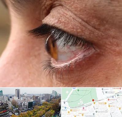 متخصص قوز قرنیه در بلوار کشاورز 