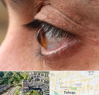 متخصص قوز قرنیه در شمال تهران 