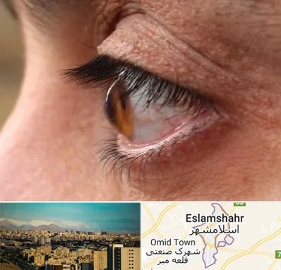 متخصص قوز قرنیه در اسلامشهر