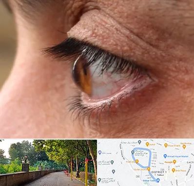 متخصص قوز قرنیه در فلکه گاز رشت