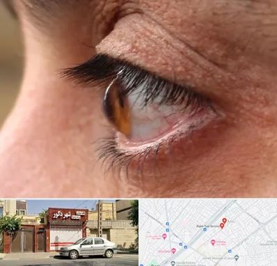 متخصص قوز قرنیه در باجک قم