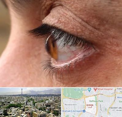 متخصص قوز قرنیه در گیشا 