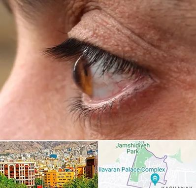 متخصص قوز قرنیه در نیاوران 