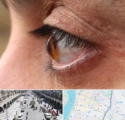 متخصص قوز قرنیه در نادری اهواز