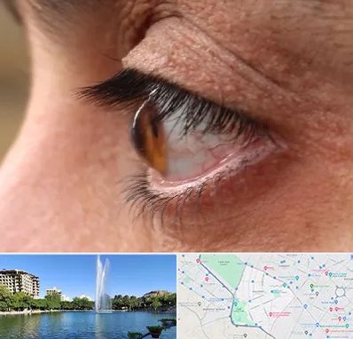 متخصص قوز قرنیه در کوهسنگی مشهد